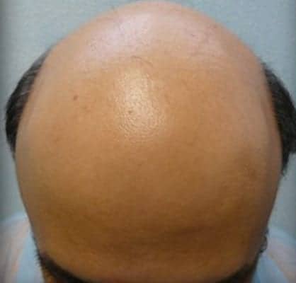 Severe Male Baldness – Dr U Hair and Skin Clinic Severe Male Baldness - Dr U Hair and Skin Clinic