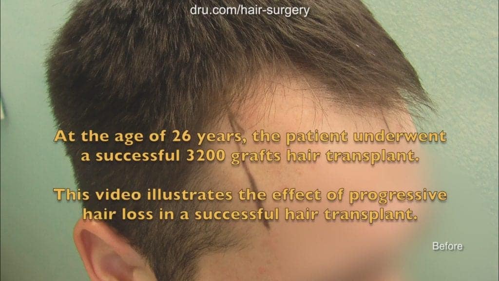 Do hair transplants last?: Patient before treatment by Dr. Umar Do hair transplants last?: Patient before treatment by Dr. Umar