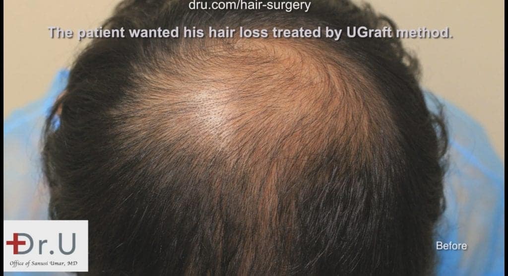 Rear view of the patient's hair loss before treatment by Dr. Umar Rear view of the patient's hair loss before treatment by Dr. Umar