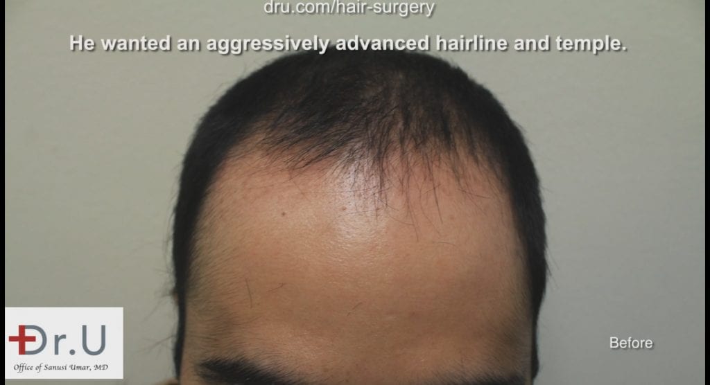 The patient experienced a receding hairline and loss of temple coverage before seeing Dr. Umar The patient experienced a receding hairline and loss of temple coverage before seeing Dr. Umar
