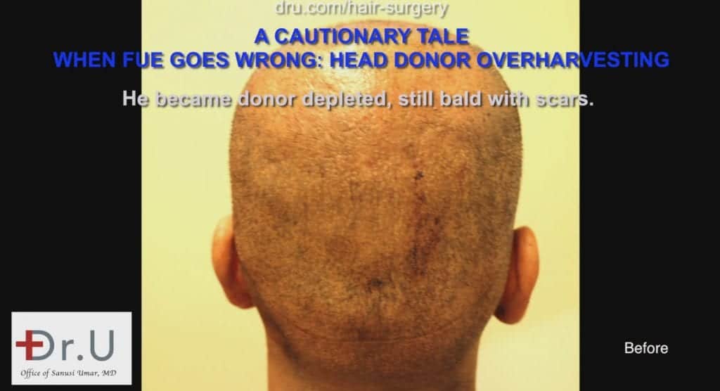 The patient experienced hair loss and scarring from a botched previous procedure The patient experienced hair loss and scarring from a botched previous procedure