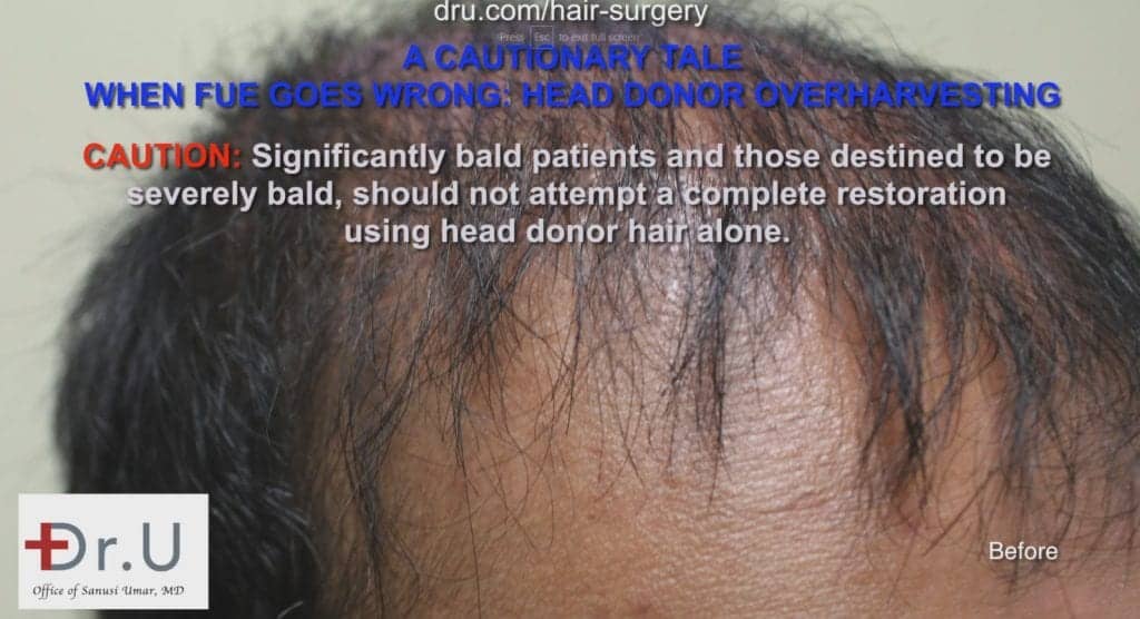Hair loss at hairline before treatment Hair loss at hairline before treatment
