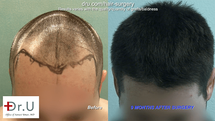 FUE hair transplant at 26: Before and After Progressive hair loss solution FUE hair transplant at 26: Before and After Progressive hair loss solution