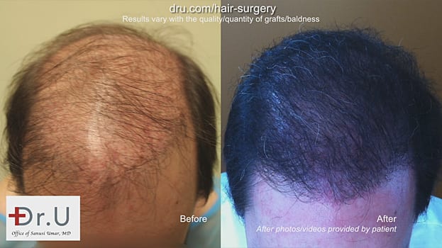 Before and After: strip surgery hair transplant repair with the Dr.UGraft Before and After: strip surgery hair transplant repair with the Dr.UGraft