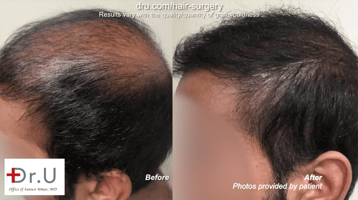 Fix old hair transplants using the DrUGraft BHT system Fix old hair transplants using the DrUGraft BHT system