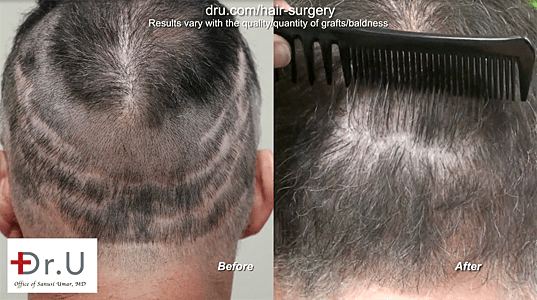 Dr.UGraft FUE Repair: Before and After Photos Dr.UGraft FUE Repair: Before and After Photos