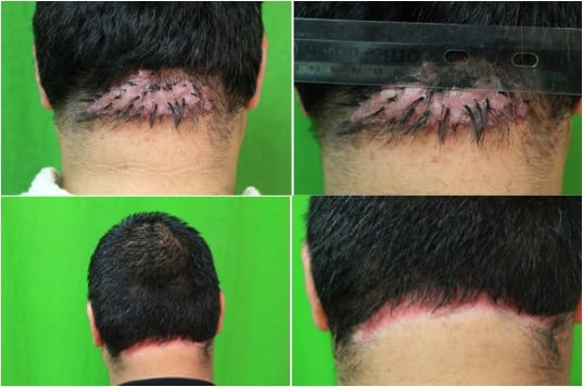 Even with a big bump on back of head, surgical removal changed this patient’s life.* Even with a big bump on back of head, surgical removal changed this patient’s life.*