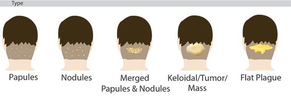 How to get rid of bumps on back of head by surgery? Acne keloidalis nuchae removal surgery is advised with merged papules & nodules.* How to get rid of bumps on back of head by surgery? Acne keloidalis nuchae removal surgery is advised with merged papules & nodules.*