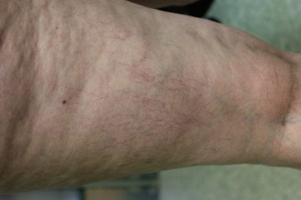 An example of telangiectasia varicose spider veins on legs before treatment. An example of telangiectasia varicose spider veins on legs before treatment.