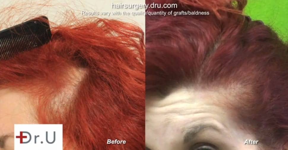There are no more signs of female hair loss at temples for this patient. There are no more signs of female hair loss at temples for this patient.