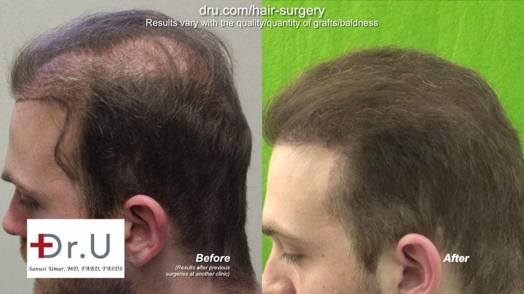 Successful strip surgery hair transplant repair before and after Successful Hair Transplant Repair of Strip Surgery