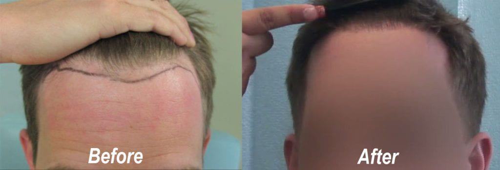 Receding hairline hair transplant before and after 1850 grafts Receding hairline hair transplant before and after 1850 grafts