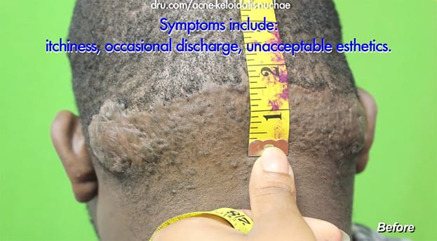 Before surgical treatment of Acne Keloidalis Nuchae mass by Dr U Before surgical treatment of Acne Keloidalis Nuchae mass by Dr U