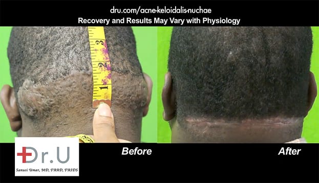 Before and After Dr U Acne Keloidalis Nuchae surgical treatment results Before and After Dr U Acne Keloidalis Nuchae surgical treatment results