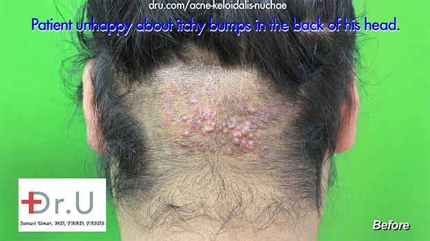 Video Dr U Akn Back Of Neck Razor Bumps Removal Surgery Results 