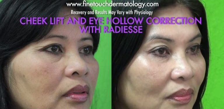 Brand names of fillers for the face may not always be as important as other considerations such as longevity, naturalness of the results and their ability to provide structural support when needed *