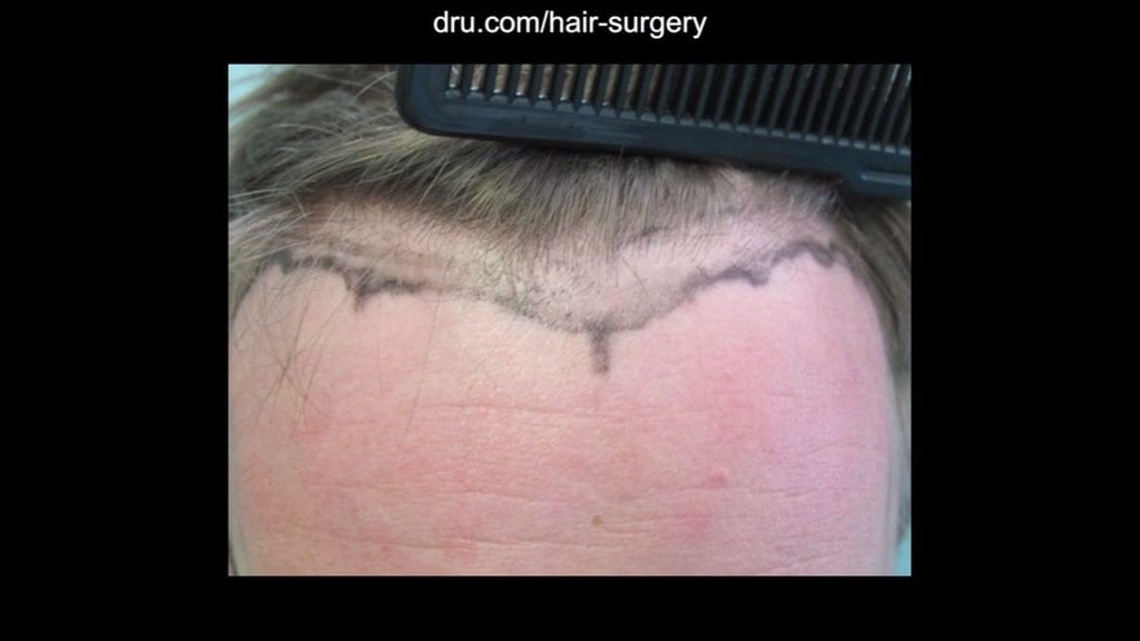 Dr. Umar worked to develop the preferred look with the patient. Dr. Umar worked to develop the preferred look with the patient.