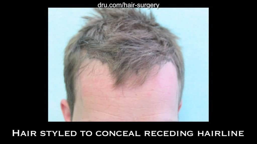 Hair loss forced this patient to keep his hair styled forward in order to camouflage his bald spot. This is an example of his hairstyle prior to receding hairline hair transplant with the Dr.UGraft. Hair loss forced this patient to keep his hair styled forward in order to camouflage his bald spot. This is an example of his hairstyle prior to receding hairline hair transplant with the Dr.UGraft.