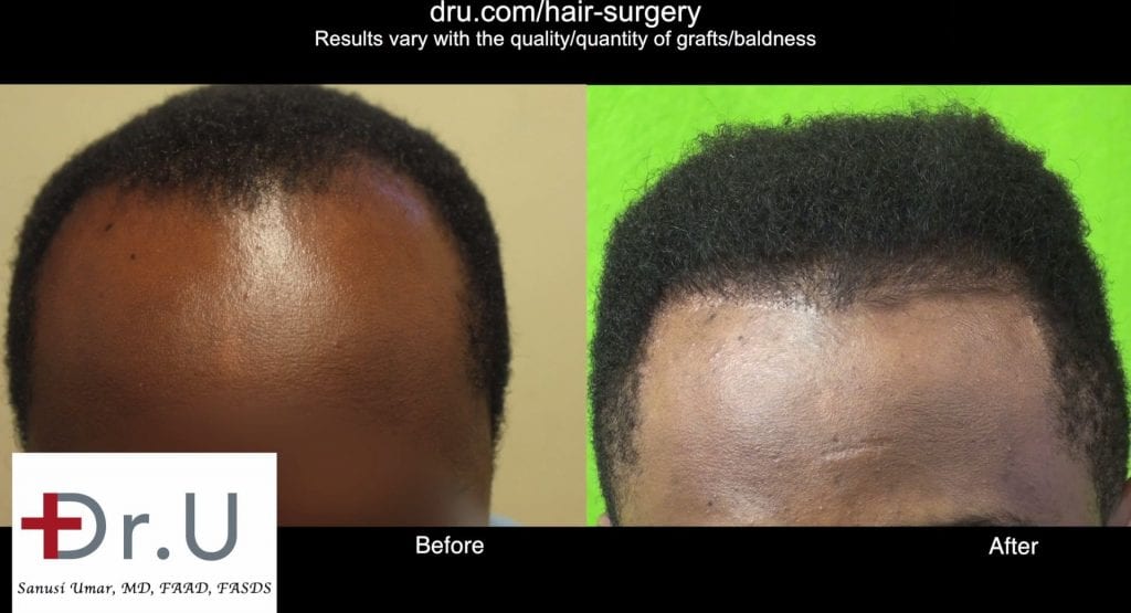 Video Linear Scar Free Black Hair Restoration For All African Hair