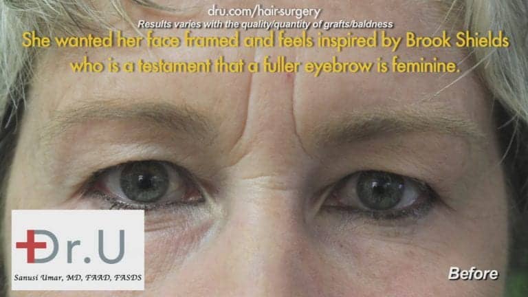 Before Eyebrow Hair Loss Treatment: Loss of hair before Dr.UGraft Before Eyebrow Hair Loss Treatment: Loss of hair before Dr.UGraft