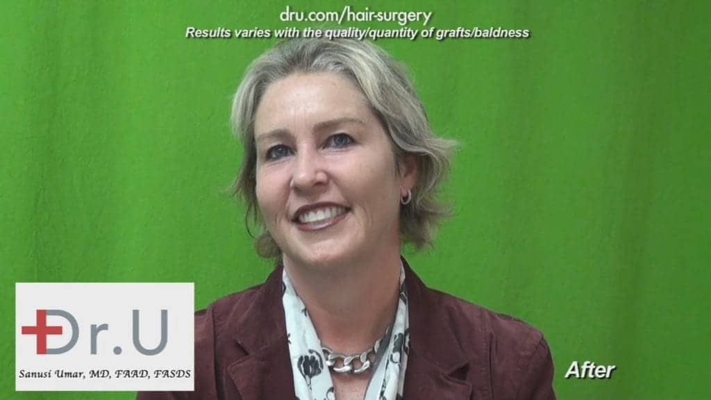Dr UGraft Surgery For Eyebrow Hair Loss Treatment Achieves Brook Shields Eyebrow Look Dr UGraft Surgery For Eyebrow Hair Loss Treatment Achieves Brook Shields Eyebrow Look