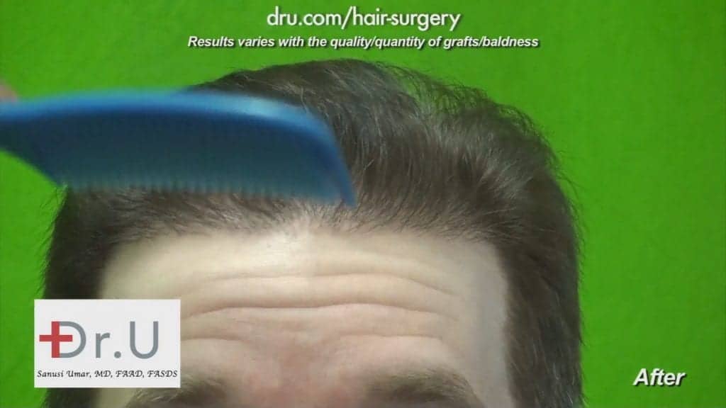 Repair Multiple Hair Transplant Surgeries: Dr.UGraft FUE Restores hair after botched surgeries with 12500 Dr.UGrafts Repair Multiple Hair Transplant Surgeries: DrUGraft FUE Restores hair after botched surgeries with 12500 Dr.UGrafts