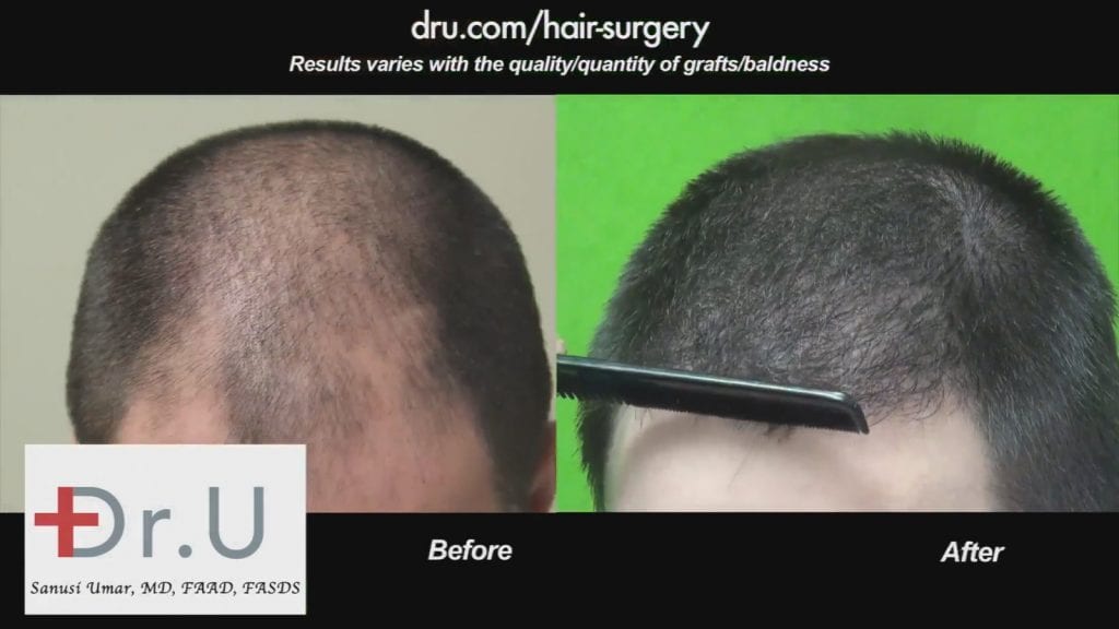 Understanding Hair Transplant Surgery Through Research Understanding Hair Transplant Surgery Through Research
