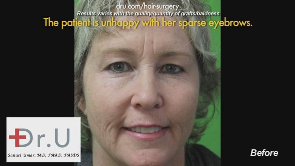 Dr.UGraft Results of Repair of Multiple Hair Transplant Surgeries Dr.UGraft Results of Repair of Multiple Hair Transplant Surgeries