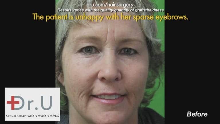 Before Dr.UGraft Eyebrow Hair Loss Treatment Before Dr.UGraft Eyebrow Hair Loss Treatment