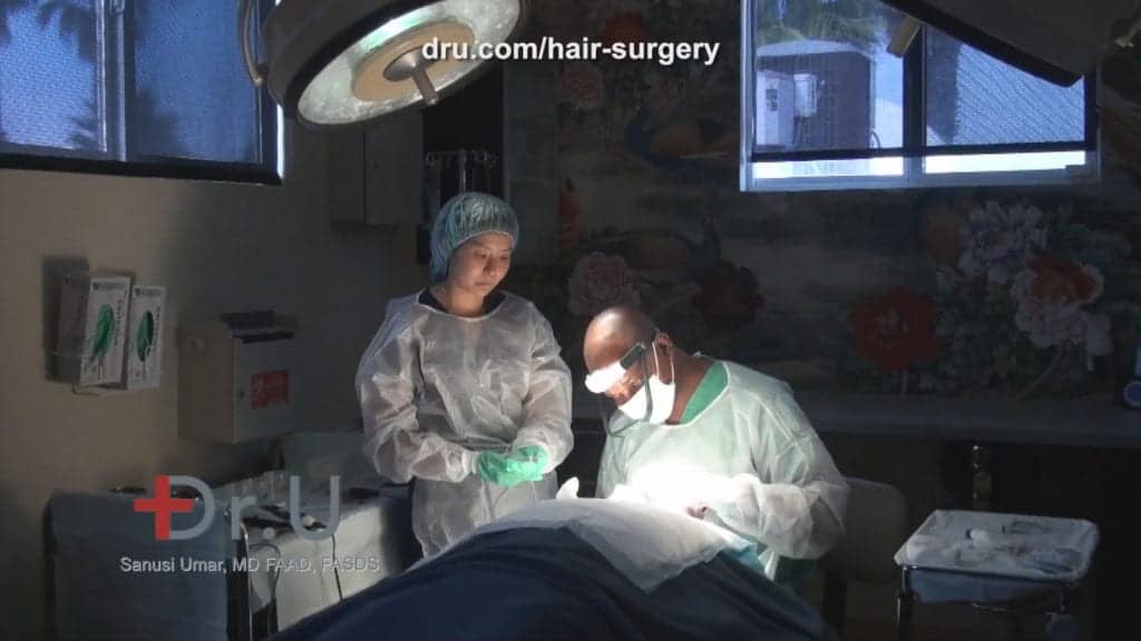 Before and After DrUGraft FUE repair with body hair transplant using 9000 Dr.UGrafts Before and After DrUGraft FUE repair with body hair transplant using 9000 Dr.UGrafts