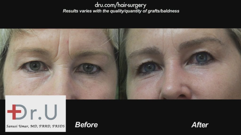 Dr.UGraft to Fix prior hair transplants Dr.UGraft to Fix prior hair transplants