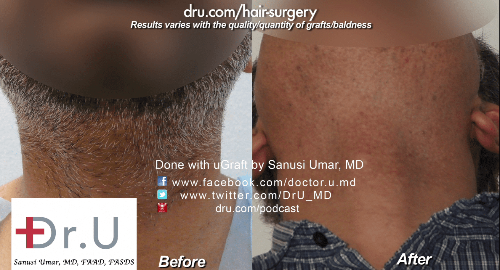 Dr. Umar used 4000 beard grafts for this procedure.* Dr. Umar used 4000 beard grafts for this procedure.*