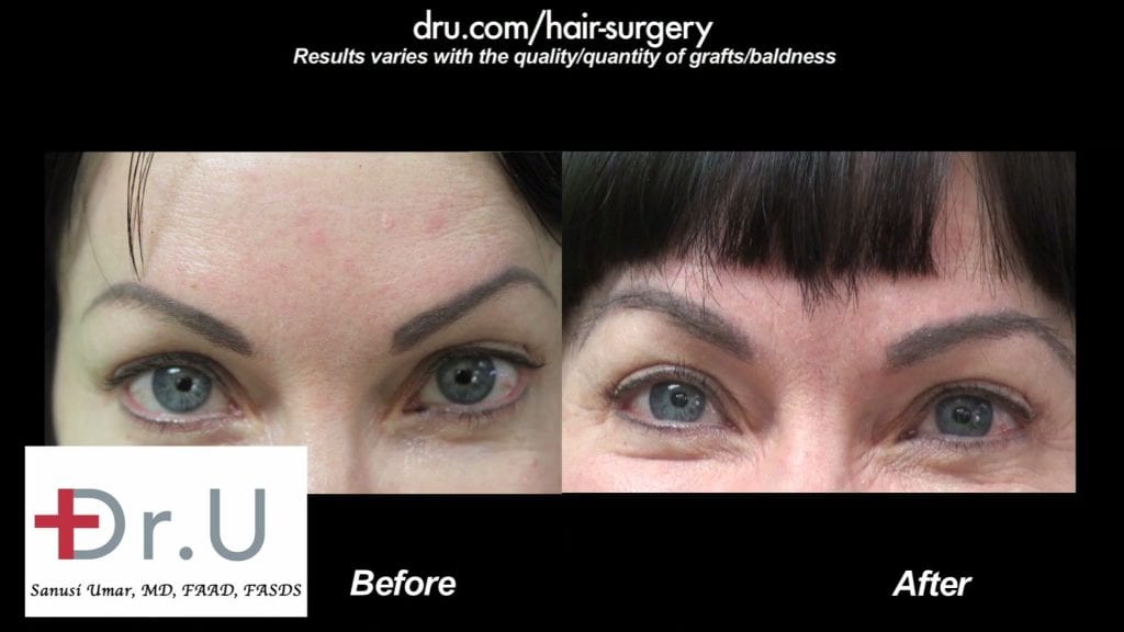 Eyebrow Hair Transplant Covers Eyebrow Tattoo Using Dr UGraft In Los Angeles Patient Before and After Photos Eyebrow Hair Transplant Covers Eyebrow Tattoo Using Dr UGraft In Los Angeles Patient Before and After Photos