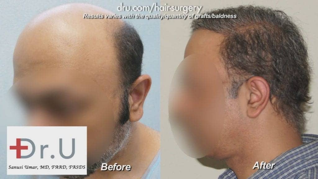The NW7 Hair Transplant used grafts from the head and beard The NW7 Hair Transplant used grafts from the head and beard