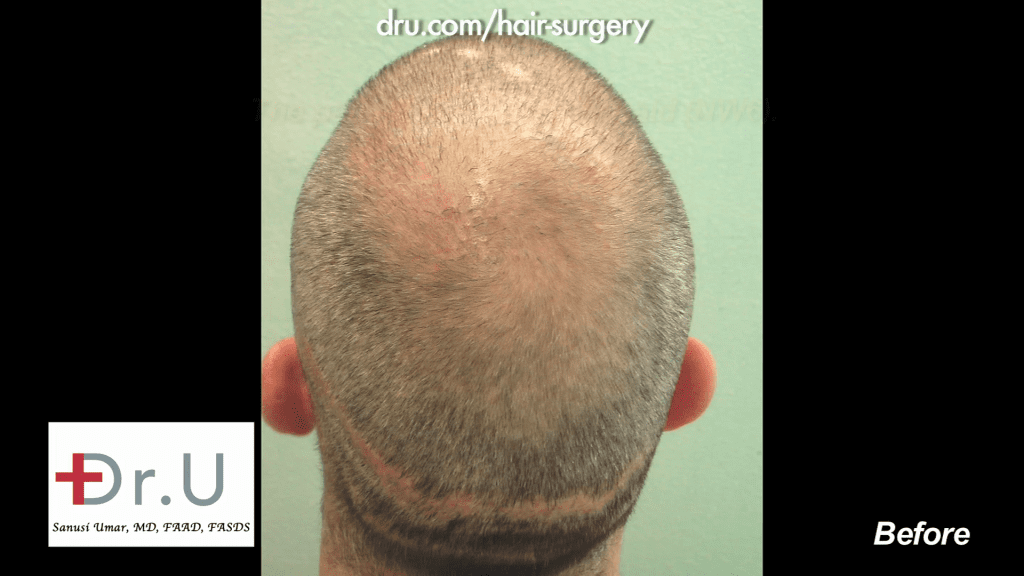 NW6 Baldness prior to being corrected with 13,500 Grafts NW6 Baldness prior to being corrected with 13,500 Grafts