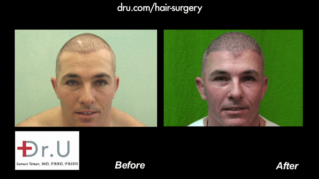 Leg and beard hair BHT before and after photos show a customized hairline the patient wanted made to his specific taste Leg and beard hair BHT before and after photos show a customized hairline the patient wanted made to his specific taste