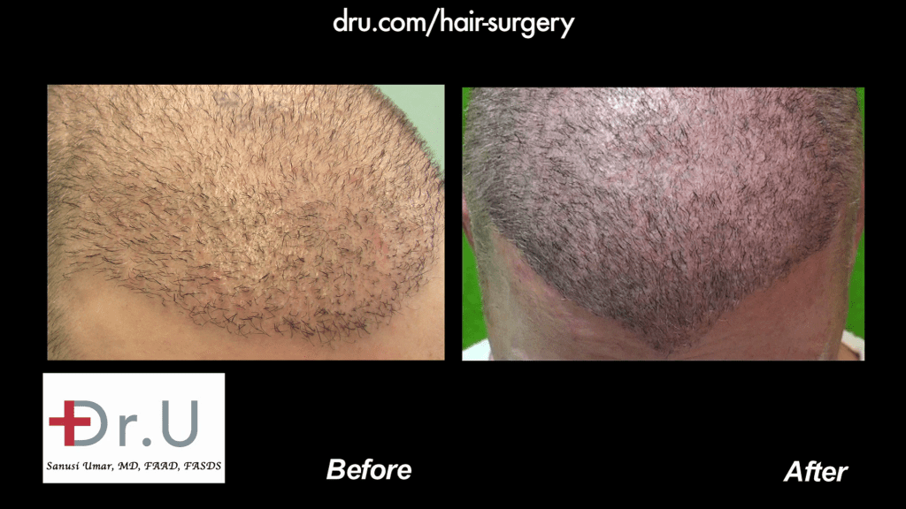 Body Hair Transplantation Restores Thinning Hairline in Males: Before and After DrUGraft Body Hair Transplantation Restores Thinning Hairline in Males: Before and After DrUGraft