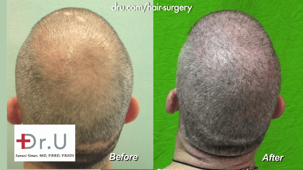 Dr UGraft Body Hair Transplantation Restores NW6 Thinning to NW 0 For A Buzz Cut before and after 13,500 Grafts Dr UGraft Body Hair Transplantation Restores NW6 Thinning to NW 0 For A Buzz Cut before and after 13,500 Grafts