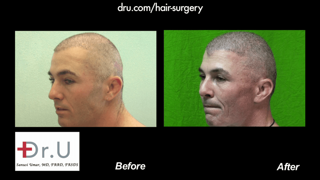 Before and after body hair transplantation restores thinning NW 6 For a Buzz Cut Before and after body hair transplantation restores thinning NW 6 For a Buzz Cut