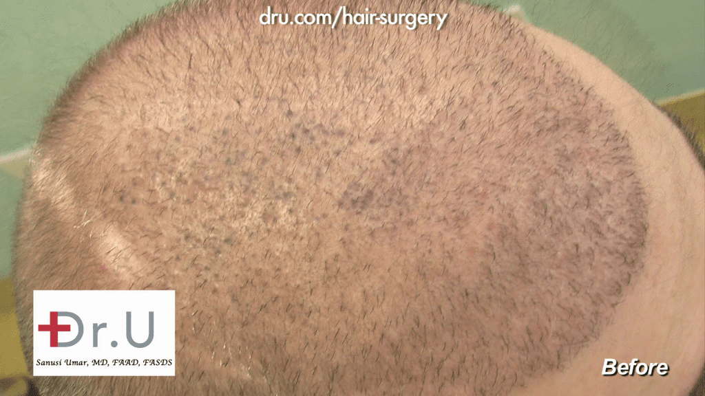 Top of patient's head depicting NW6 Baldness (eventually corrected with 13,500 DrUGrafts) Top of patient's head depicting NW6 Baldness (eventually corrected with 13,500 DrUGrafts)
