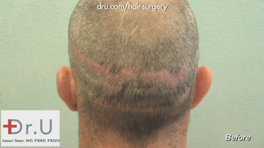 Before Hair Transplant Scar Revision: visible scarring Before Hair Transplant Scar Revision: visible scarring