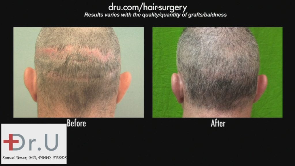 An example of a botched hair surgery successfully restored by Dr. U using the Dr.UGraft™ system.* An example of a botched hair surgery successfully restored by Dr. U using the Dr.UGraft™ system.*