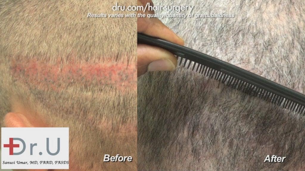 FUE hair transplant from beard: Hair transplant scar revision before and after FUE hair transplant from beard: Hair transplant scar revision before and after
