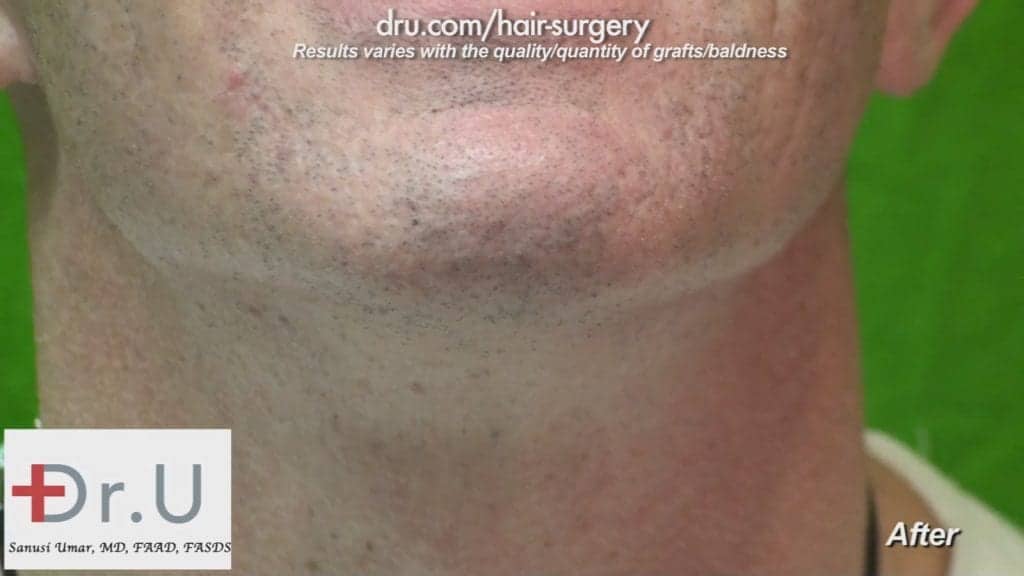 FUE hair transplant from beard: The Dr.UGraft procedure left the patient with little to no trace of scar tissue or wounds. FUE hair transplant from beard: The Dr.UGraft procedure left the patient with little to no trace of scar tissue or wounds.
