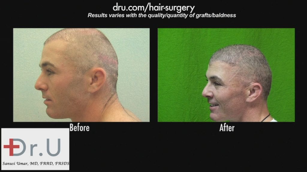 Hair transplant scar cover up using FUE using beard hair Hair transplant scar cover up using FUE using beard hair