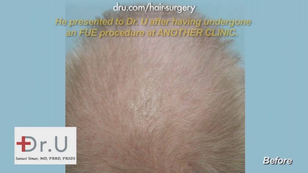 After his Indian FUE hair Transplant, He was still bald. After his Indian FUE hair Transplant, He was still bald.