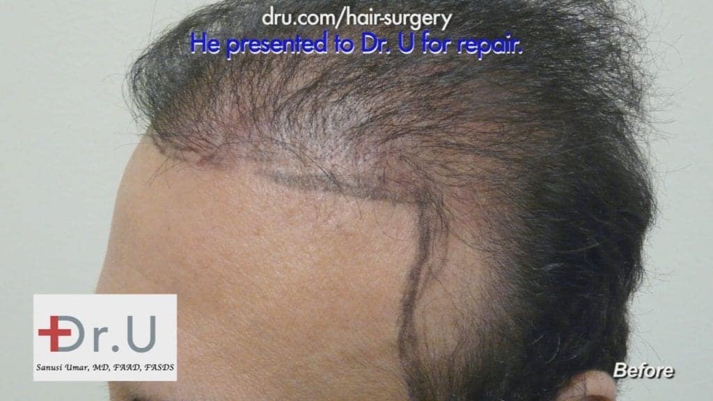 Hair Restoration and Transplant Repair: Before Treatment Hair Restoration and Transplant Repair: Before Treatment