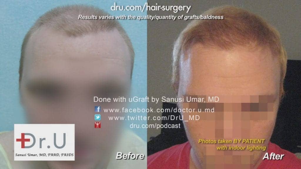 Crooked hairline repair - Before and After Crooked hairline repair - Before and After