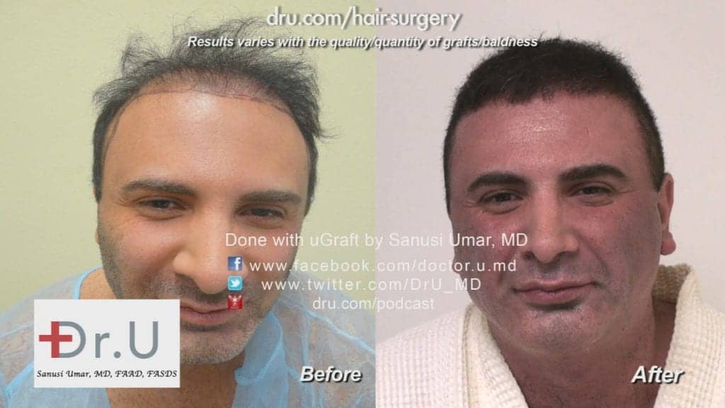 Hairline before and after repair with body hair transplant Hairline before and after repair with body hair transplant