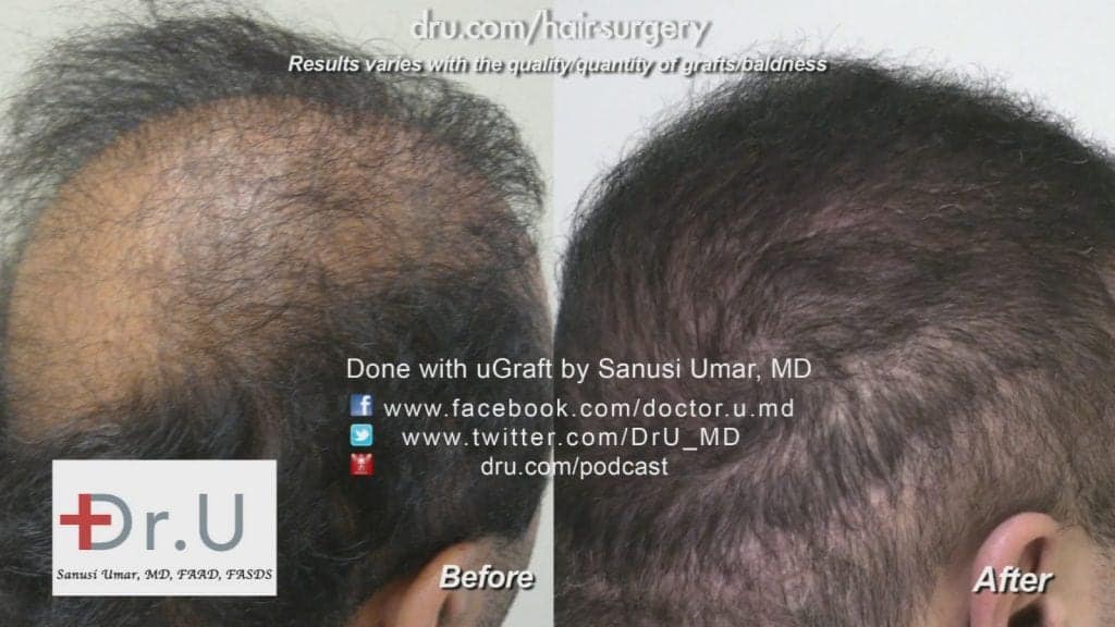 Before and after Dr.UGraft: the patient's crown Before and after Dr.UGraft: the patient's crown